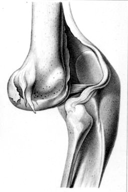 Knee Dislocated Backward